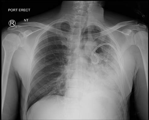 Are there home remedies for pulmonary edema? Doubling Down on Re-Expansion Pulmonary Edema: Treatment ...