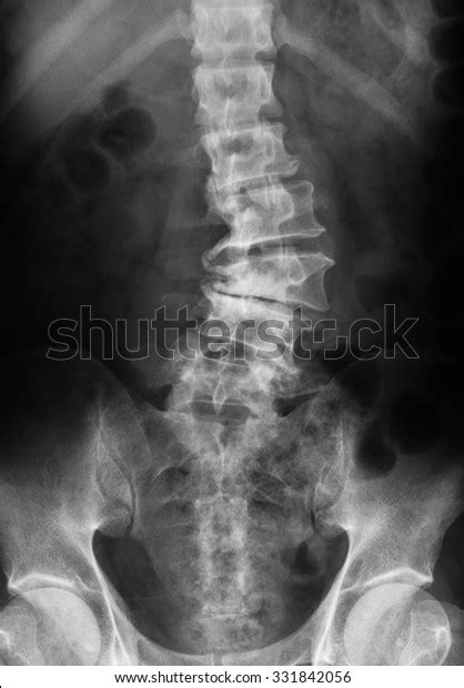 The spine is divided into several sections. Xray Image Lumbosacral Spine Showing Osteoarthritis Stock ...