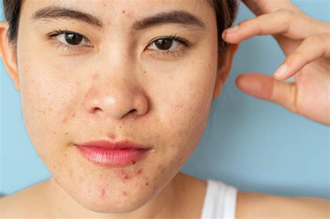 5 Ways To Treat Hormonal Acne Breakouts Mommy B Knows Best