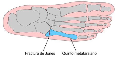 Fractura Del Quinto Metatarsiano Causas Síntomas Y Tratamiento