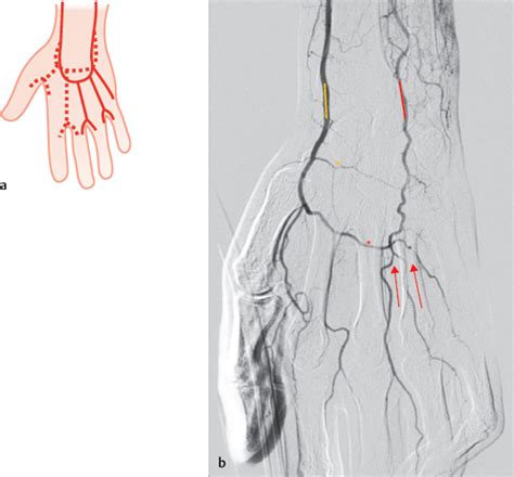 Deep Palmar Arch And Palmar Digital Arteries Radiology Key