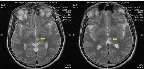Shows T2 Weighted Mri Of The Patients Brain In Axial Cuts The Yellow