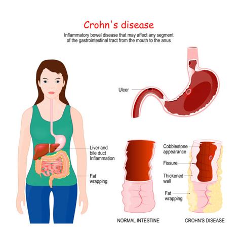 Colon Cancer Infographic Stock Photos Pictures And Royalty Free Images