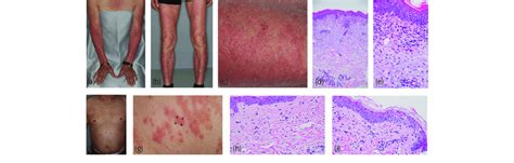 Clinical And Histological Features Case 1 A E Skin Eruption On Both