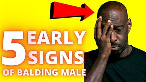 Symptoms Of Hair Loss In Men Early Signs Of Balding Male Youtube