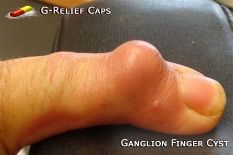 Ganglion Cyst Finger Surgery Alternative G Relief Caps100 Natural