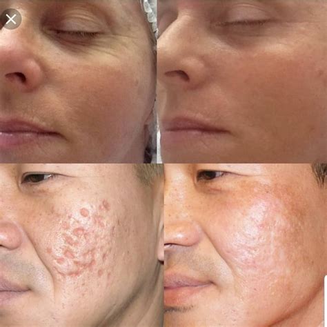 Dermapen Before And After Photos