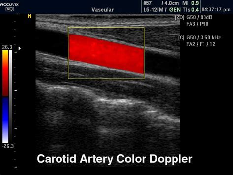 Ultrasound Images • Common Carotid Artery Color Doppler Echogramm №328