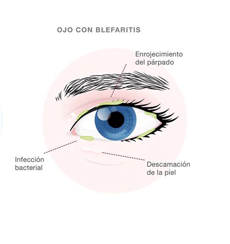 ¿qué Es La Blefaritis CoruÑa VisiÓn Clínica Ocular Oftalmológica