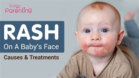 Rash On Babys Face Reasons And Remedies Youtube