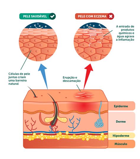 Dermatologia Quais São Os Principais Tipos De Doenças Eczematosas