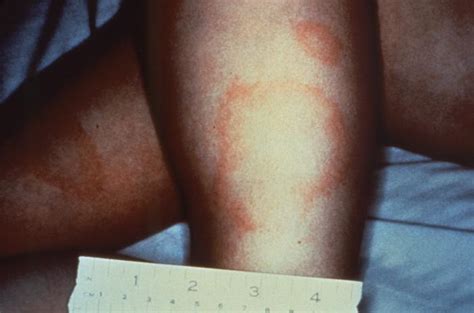 Lyme Disease Physical Examination Wikidoc