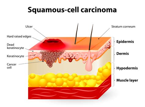 1b4 Skin Cancer Humanbio