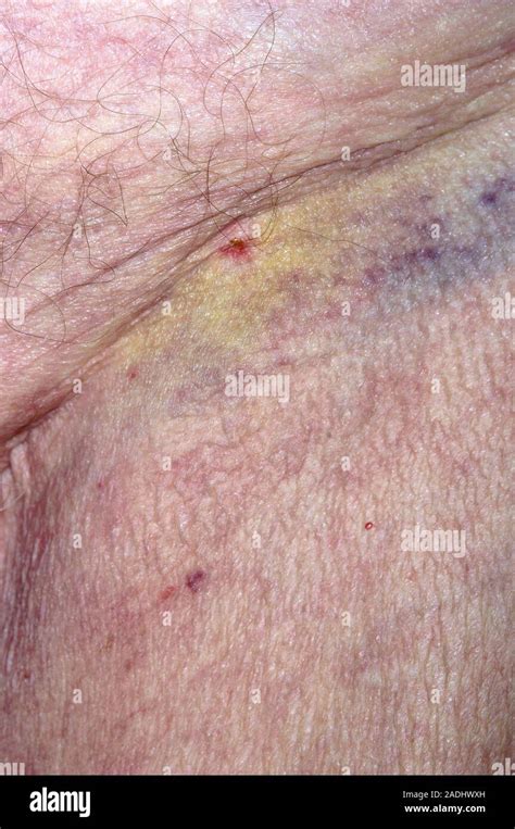 Angioplasty Incision Bruise And Incision Wound In The Groin Of A 90