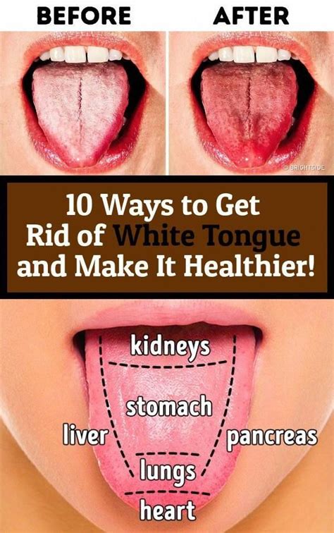 10 Ways To Get Rid Of White Tongue And Make It Healthier White