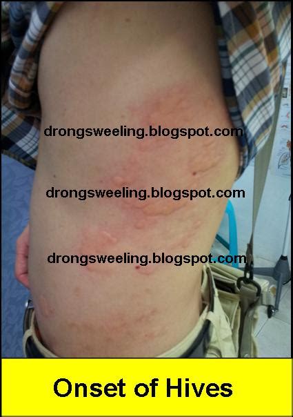 Tcm News Can Tcm Chinese Doctor Cure Hives