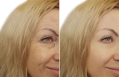 Anti Wrinkle Injections Gold Coast Wrinkle Reduction Treatment