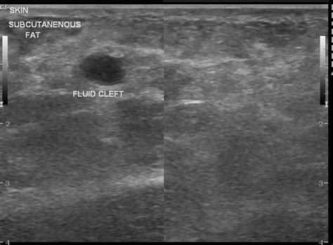 Subcutaneous Fat Contusion Ultrasound Image