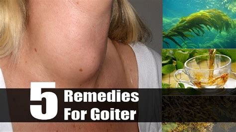 5 Useful Home Remedies For Goiter By Top 5 Youtube