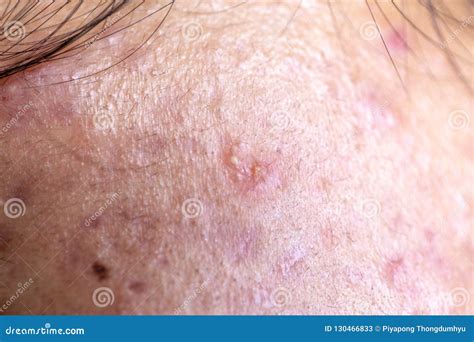 Backgrounds Of Lesions Skin Caused By Acne On The Face Royalty Free