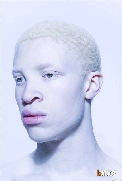 Albino ljudi | Batice