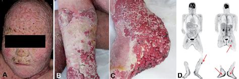 Squamous Cell Carcinoma Arising From Keratitisichthyosis