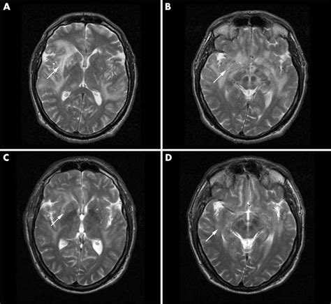 Cerebral Vasculitis As A Primary Manifestation Of Systemic Lupus
