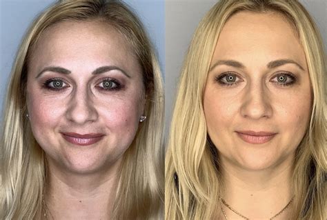 Buccal Fat Removal Before And After Photos Arroyo Plastic Surgery