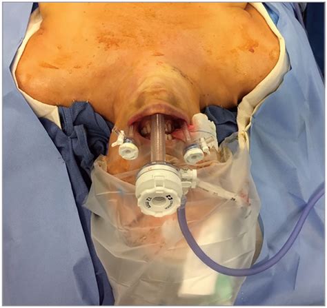 Transoral Endoscopic Thyroidectomyan Emerging Remote Access Technique