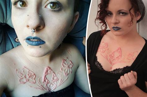 Woman Spends Six Hours Getting Skin Cut Off For Scar Tattoo Daily Star