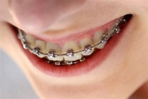 Invisalign Braces Ting Dental Your Partner In Healthy Smile