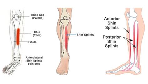 The Best Exercises To Prevent Shin Splints Best Physical Therapy