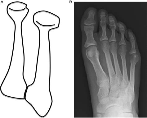 Fifth Metatarsal Osteotomy Techniques In Foot And Ankle Surgery