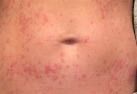 Rash On Stomach Itchy Red Heat Rash On Baby STD Lower Side Back Chest And Stomach Rash