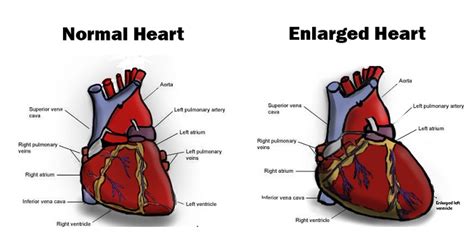 Reasons For An Enlarged Heart