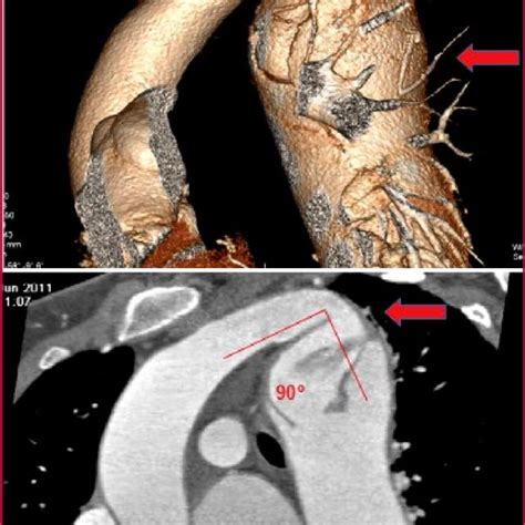 A Preoperative 3d Angio Ct Reconstruction Stage 1 Depicting Aortic