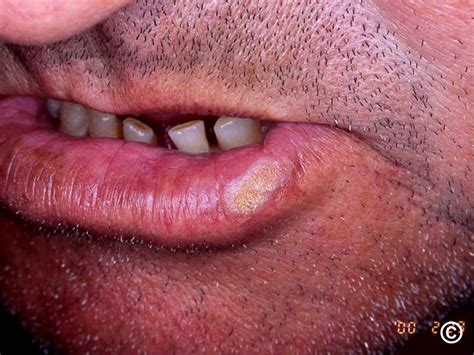 Squamous Cell Skin Cancer Lip D68