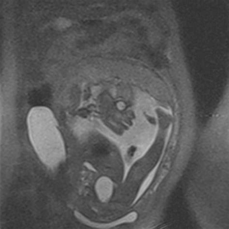 Pdf Torsion Of Ovarian Cyst During Pregnancy A Case Report
