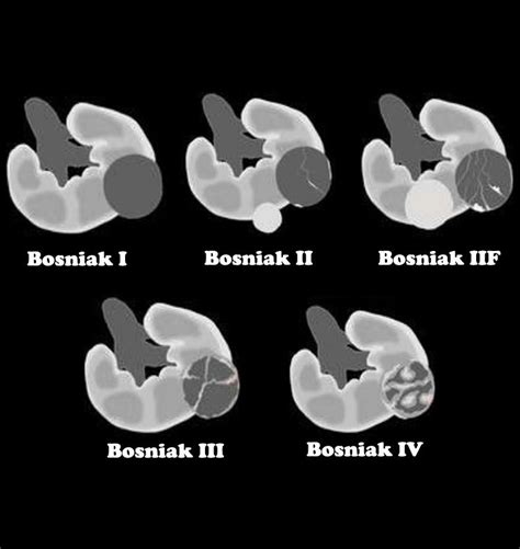Bosniak Classification For Renal Cysts Diagnostic Medical Sonography Radiology Imaging Radiology