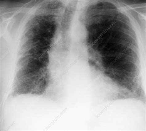 Fibrosing Alveolitis X Ray Stock Image C0103512 Science Photo Library