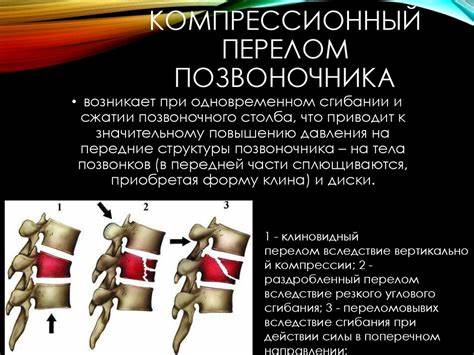 Компрессионный перелом позвоночника диета Компрессионные переломы позвоночника. Клиника - online presentation Компрессионные переломы позвоночника. Клиника - online presentation Компрессионный перелом позвоночника диета
