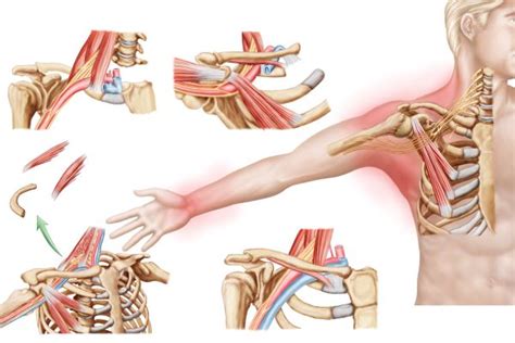 Thoracic Outlet Syndrome Tos Stony Brook Medicine