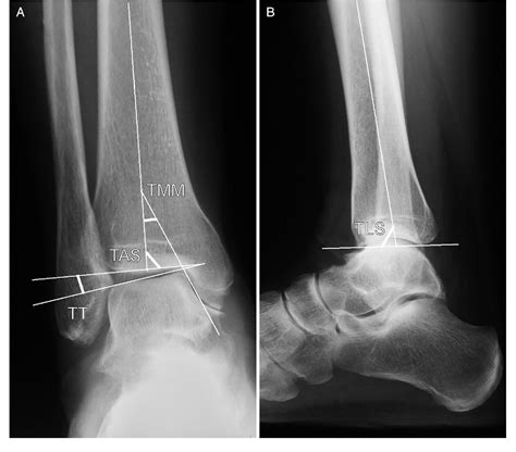 Figure 3 From Treatment Of Varus Ankle Osteoarthritis And Instability
