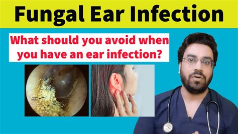Fungal Ear Infection Otomycosis Causes Symptoms And Treatment Ear