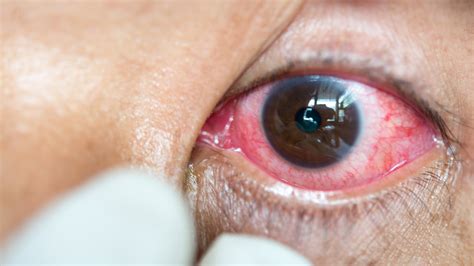 Sleeping In Contacts Could Result In Serious Eye Infections Fox News