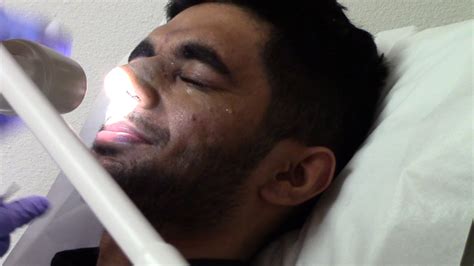 Nasal splints are usually necessary to treat a broken nose. Nasal Splint Removal after Rhino/Septoplasty - YouTube