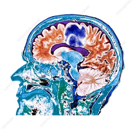 Glioblastoma Brain Cancer Ct Scan Stock Image F0238542 Science