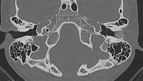 Malignant Otitis Externa Radiology