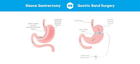 Gastric Sleeve Or Lap Band Surgery What Is Best For You