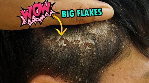 Dry Flaky Scalp Removal Dandruff Scratching Satisfying 274 Youtube